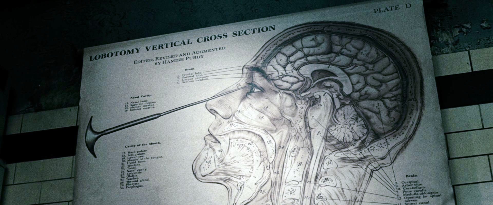 What is a lobotomy Effects of lobotomy 52 What is a lobotomy Effects of lobotomy 22